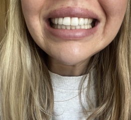 Unsure on Invisalign results