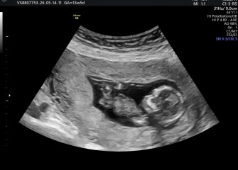 Pregnant with my third, any guesses on baby's sex tomorrow?