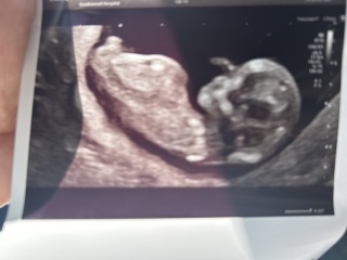 Pregnancy nub and skull theory guesses: boy or girl?