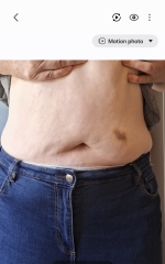 Anyone else find Wegovy injections sting more than Mounjaro?