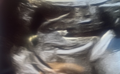 Conflicting scan results on baby's sex at 22 weeks