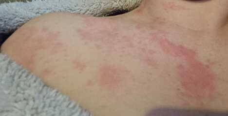 What is this rash