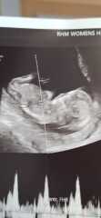 Boy or Girl?