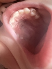 3.5 year olds teeth