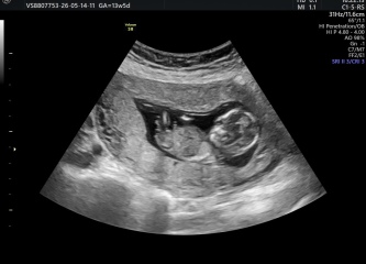 Pregnant with my third, any guesses on baby's sex tomorrow?