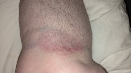 AIBU to ask if this arm wound needs attention? Contains a bloody pic of said wound