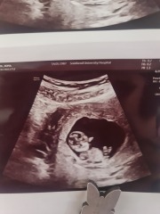 Boy or girl guesses for my pregnancy