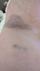 AIBU to ask if this arm wound needs attention? Contains a bloody pic of said wound