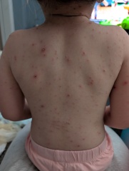 Chicken pox - is this normal?!