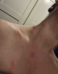 What is this rash