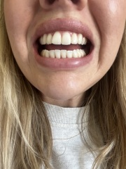 Unsure on Invisalign results