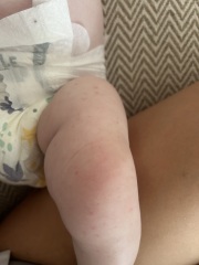 Does this look like heat rash?