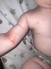 10 month old with a really bad rash! Any idea what it looks like/ could be and desperate for some home remedies.