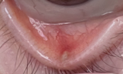 Is this a stye or a chalazion?  Back to pharmacist?