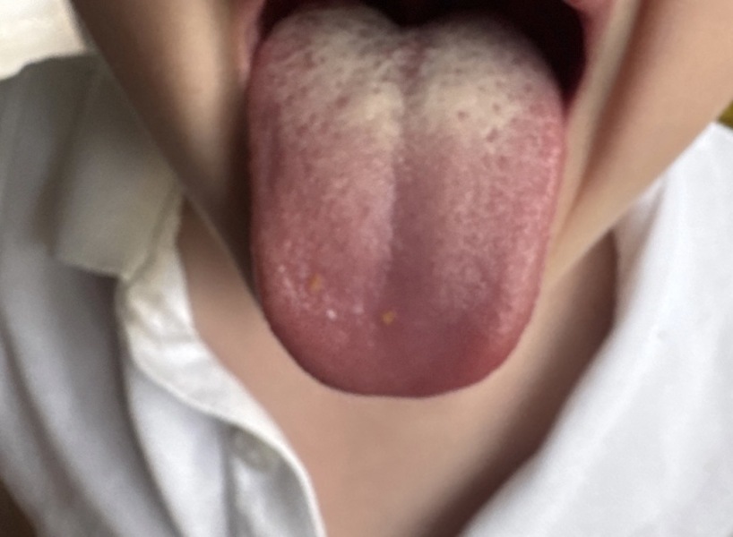 White patches at back of tongue