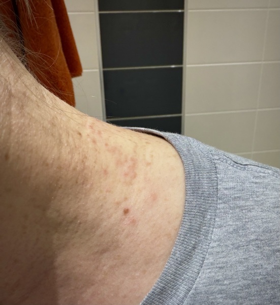 Rash for 3 months - please help!