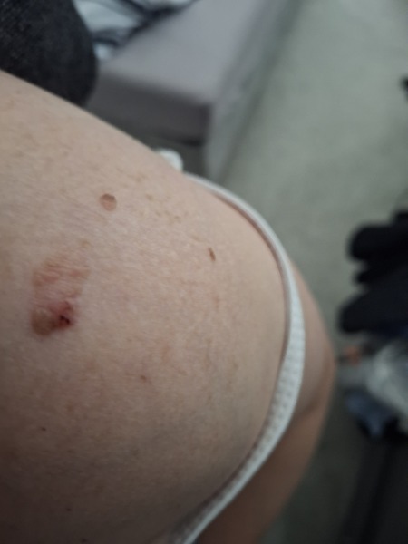 Any dermatologists here? Df thinks I may have skin cancer?