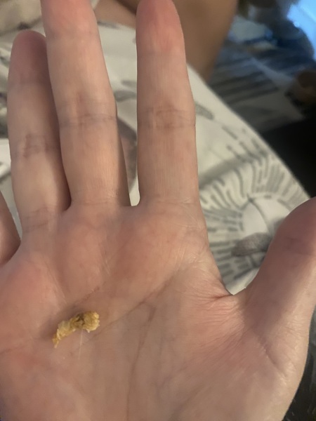 Ear wax lump from hell