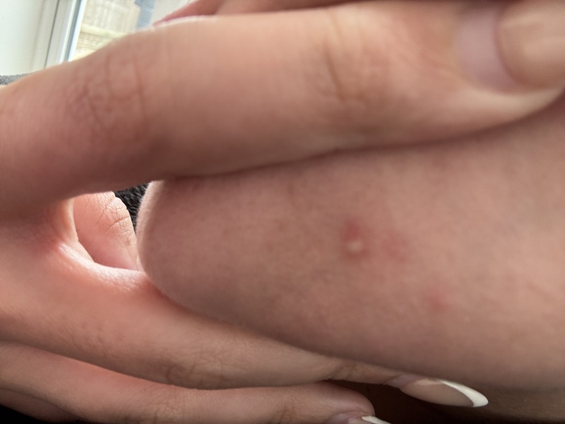 Small persistent bump being checked and trying not to panic