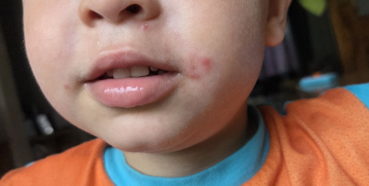 Persistent rash at the corner of my child’s mouth, any ideas?