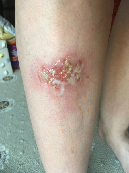 Has anyone had an insect bite go like this?