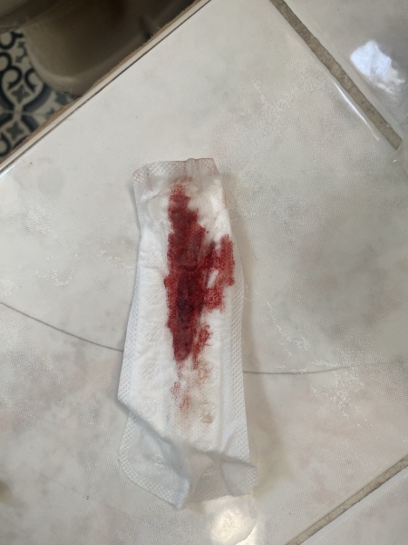 Bleeding at 7 weeks