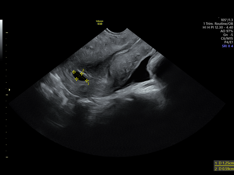Private scan at 6 weeks from last period and possible ectopic pregnancy concerns