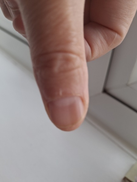 Biopsy