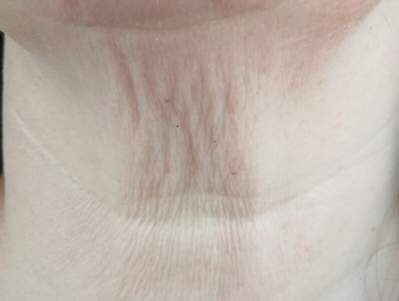Any non-invasive treatments or exercises that help improve neck skin?