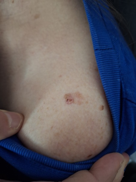 What is this mole?
