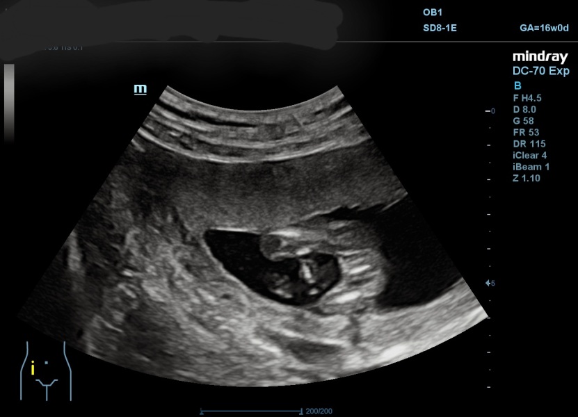 Has anyone been told the wrong sex at a 16 week scan?