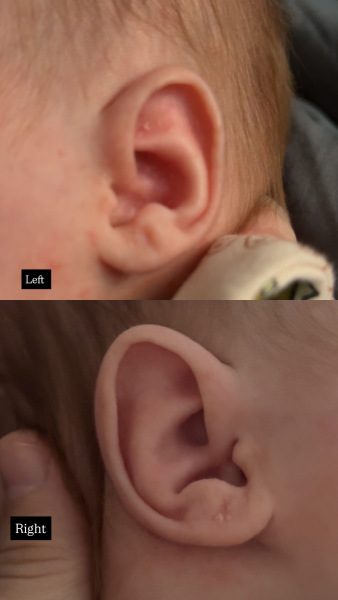 Noticed my seven-week-old baby’s ears look very different