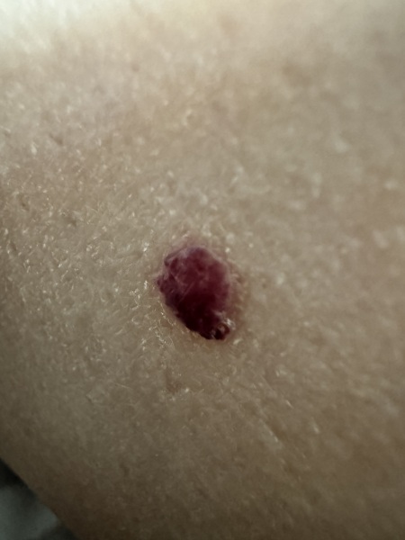 Darkened raised skin mark changing colour over the past year