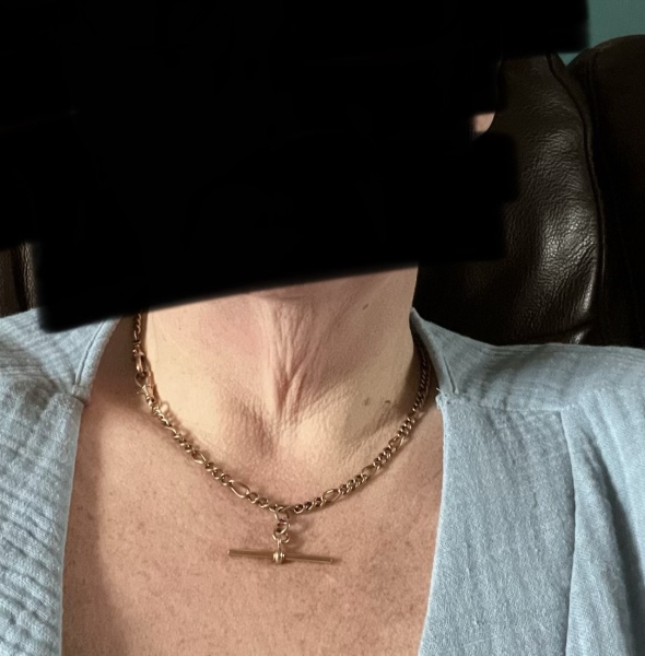 Crepey turkey neck after weightloss
