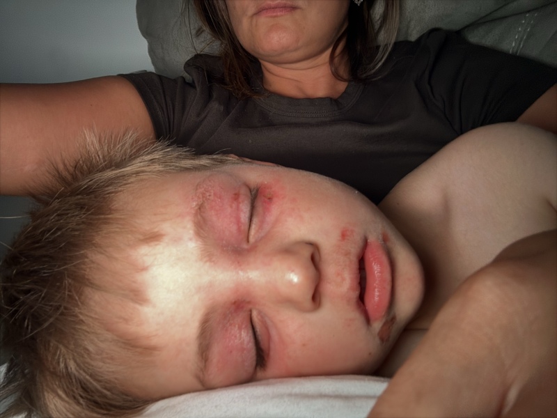 Methotrexate experiences? 4 year old with severe atopic dermatitis