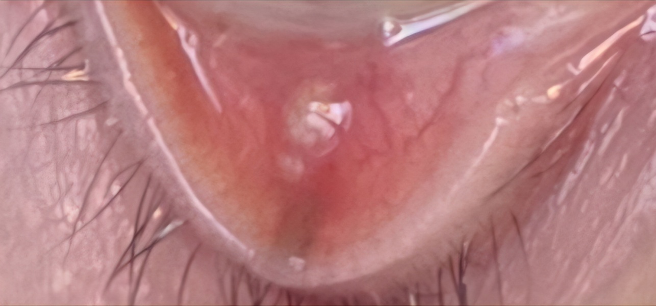 Is this a stye or a chalazion?  Back to pharmacist?