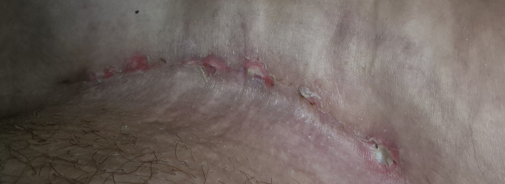 C-Section Infection? Push for it be rechecked?