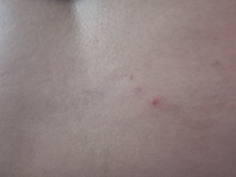 Red spot on back persistant scab please help