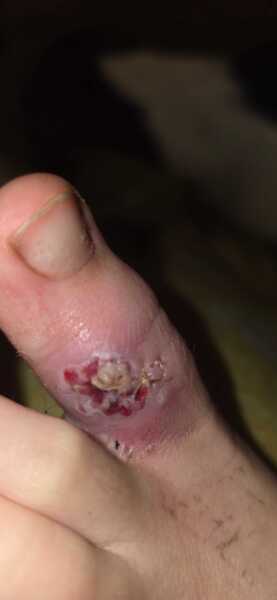 2 week cancer referral for 12 year old...mole