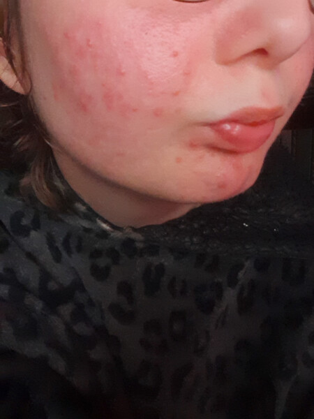 Is this normal acne for an 18 year old [pic!] ?