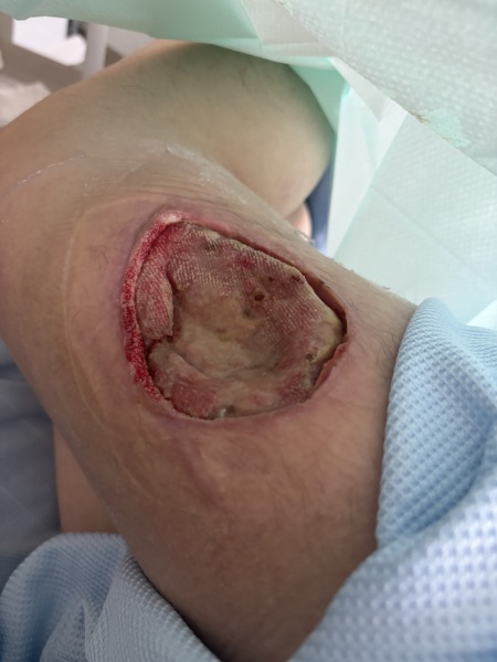 Chronic wound after dog attack, 6 months later