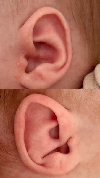 Has anyone seen this kind of mild ear deformity in a baby?