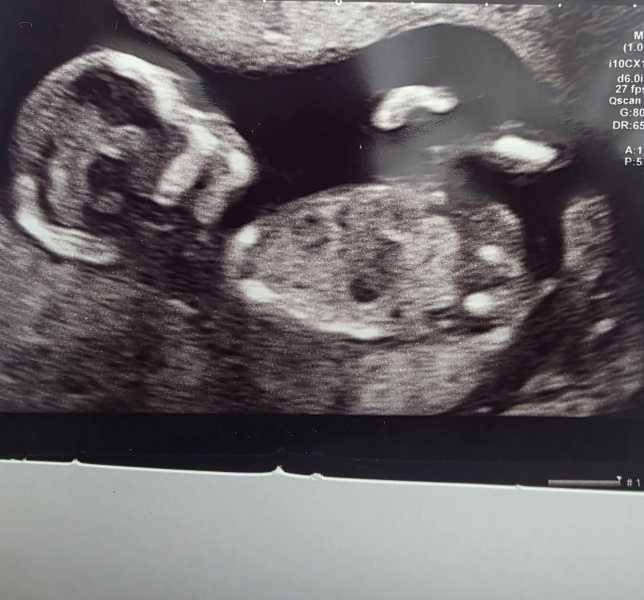 Gender prediction 14 week scan