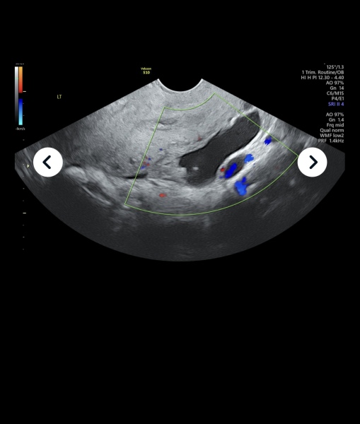 Private scan at 6 weeks from last period and possible ectopic pregnancy concerns