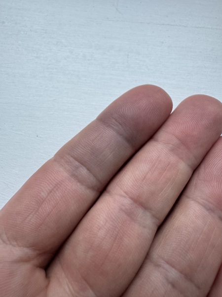 Sudden swollen finger joint - what could be causing it?