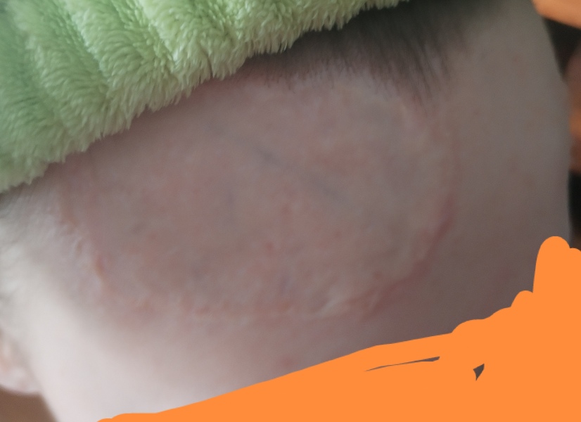 Daughter in hospital - full thickness burns