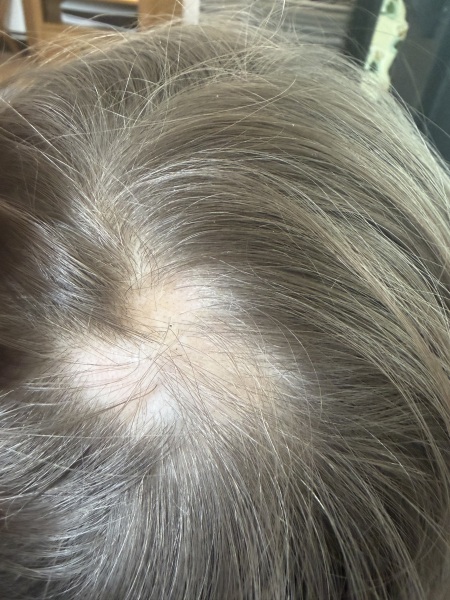 Child with ?Alopecia Areata