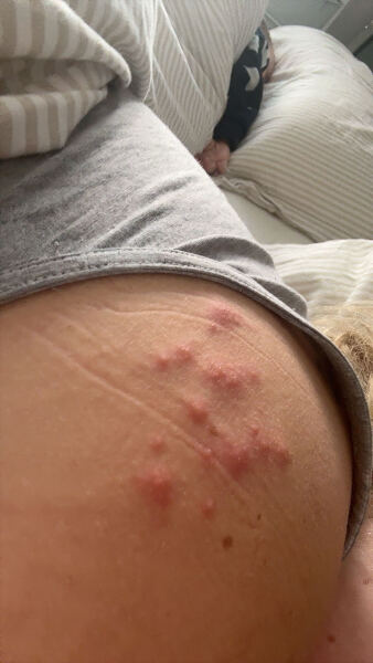 Shingles ??