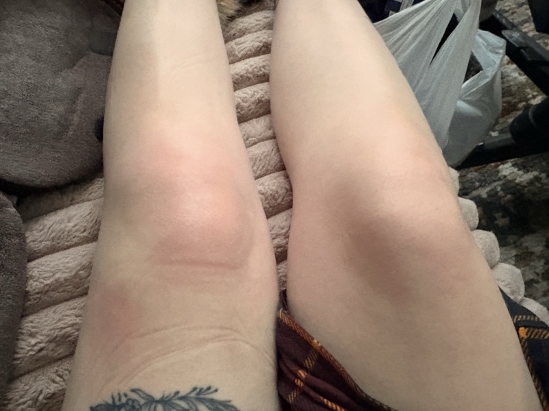 Knee dislocation & recovery