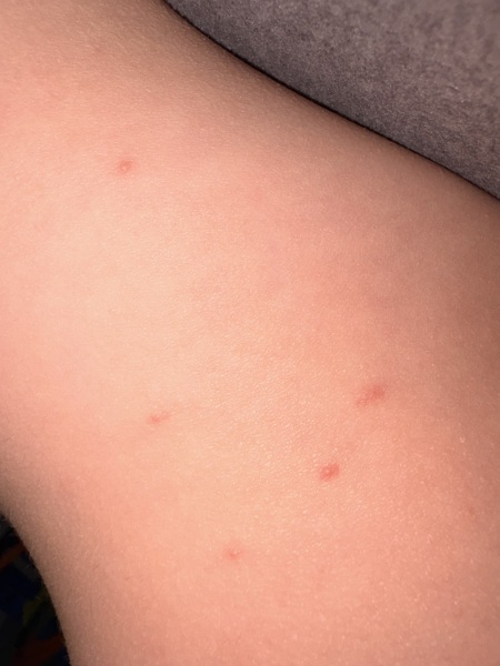 Could this be a second, milder case of chickenpox in my son?
